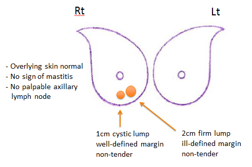 lumpy breast after weaning